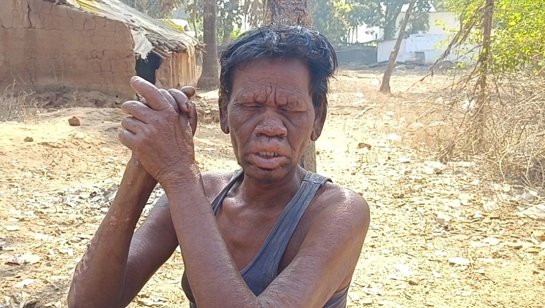 वृद्ध व अपाहिज सी जिंदगी जी रहा है कूकानार का युवक जगत