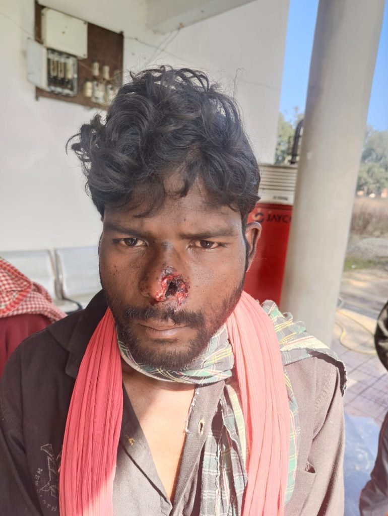 बकरा शिकार बंटवारे को लेकर हुआ मारपीट,नाक को दांत से इस क़दर काटा कि नाक का मांस कट गया, हुआ अपराध दर्ज।